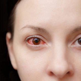 red eyes due to energy drinks